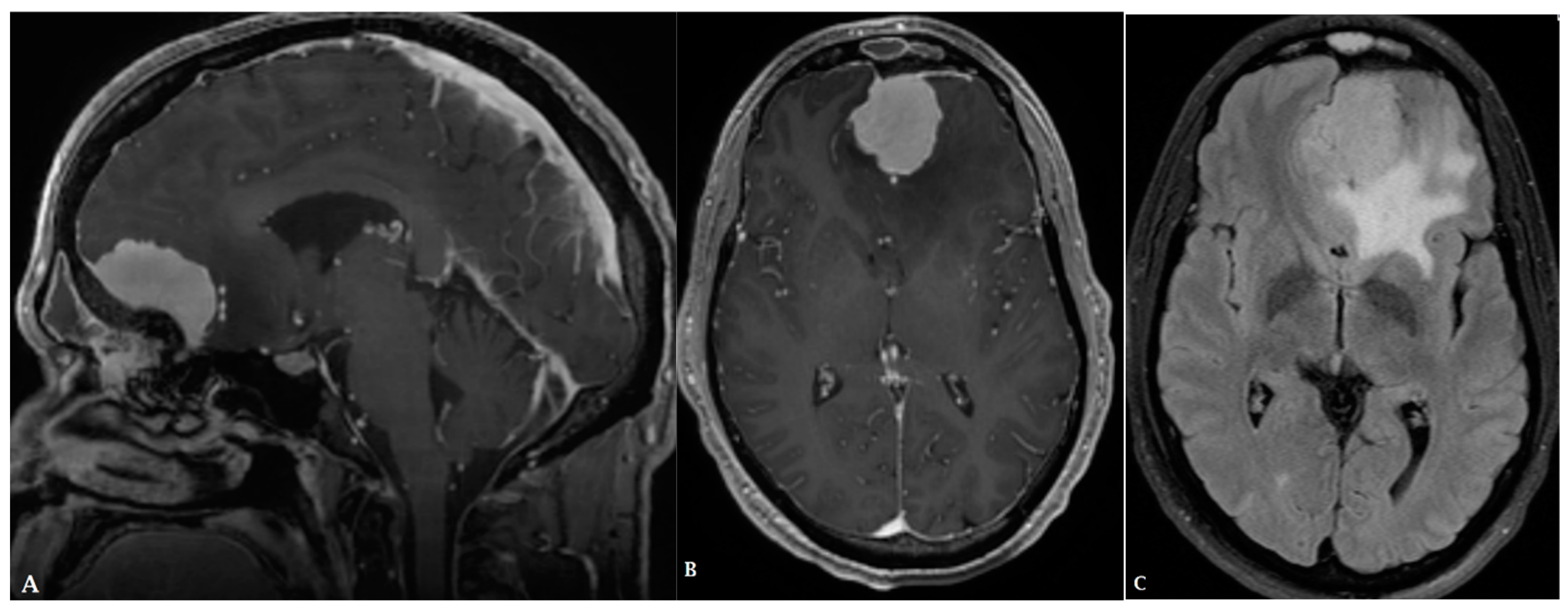 Brain cancer MRI scan