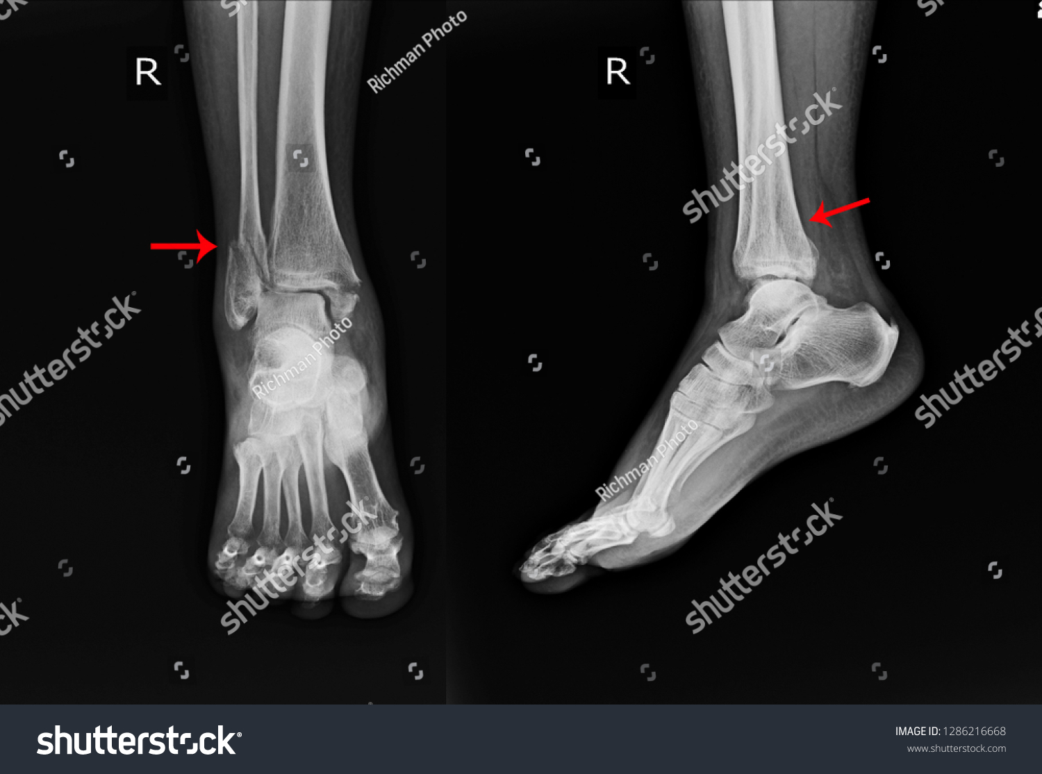 stock-photo-x-ray-right-ankle-a-female-year-old-accident-showing-spiral-fracture-of-distal-fibula-at-level-1286216668.jpg