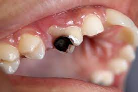 caries (2).jpg