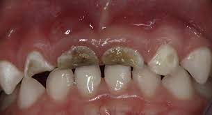 caries (1).jpg